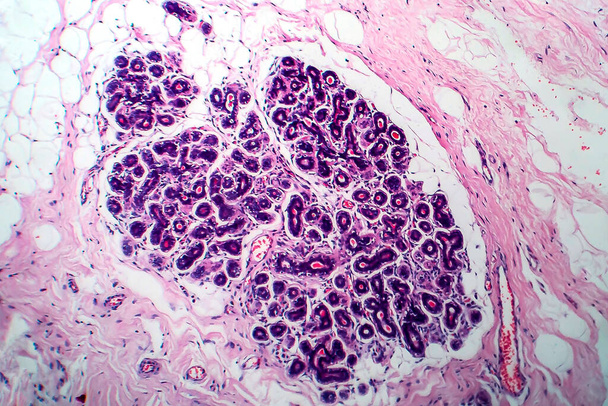 Рак молочної залози, легкий мікрограф, фото під мікроскопом
 - Фото, зображення