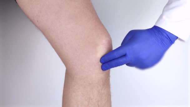 Ένας άντρας υποφέρει από πόνο στο γόνατο. Εξέταση από ορθοπεδικό και τραυματολόγο. Ερυθρότητα και πρήξιμο των ποδιών, ρήξη μηνίσκου ή θυλακίτιδα του γόνατος - Πλάνα, βίντεο