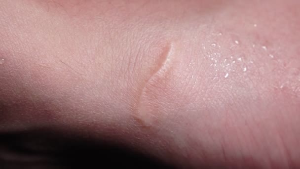 close-up van het litteken op de arm, glas gesneden, macro. selectieve focus - Video
