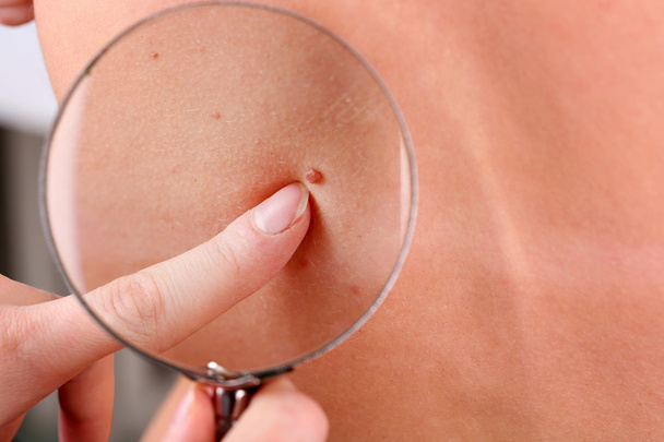 Dermatologist examines a birthmark of patient, close up - Fotoğraf, Görsel