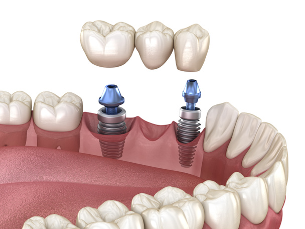 Puente dental soportado por implantes. Ilustración 3D médicamente precisa del concepto de dientes humanos y prótesis dentales
 - Foto, imagen