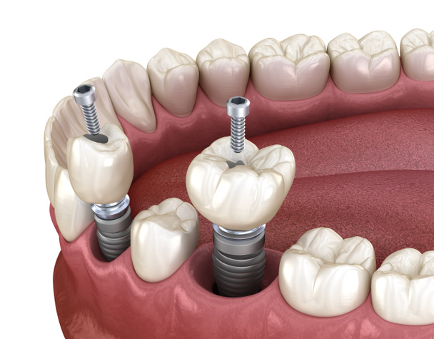 Azı dişi ve azı dişi yerleştirme implantın üzerine, vida saplantısı. Diş tedavisinin 3B illüstrasyonu - Fotoğraf, Görsel