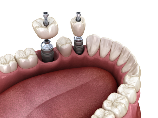 Azı dişi ve azı dişi yerleştirme implantın üzerine, vida saplantısı. Diş tedavisinin 3B illüstrasyonu - Fotoğraf, Görsel
