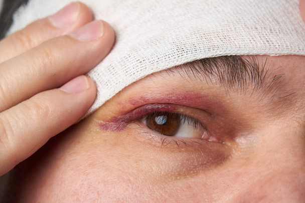Nahaufnahme eines Blutergusses in der Nähe des Auges, das Gesicht eines Mannes mit Hämatom - Foto, Bild