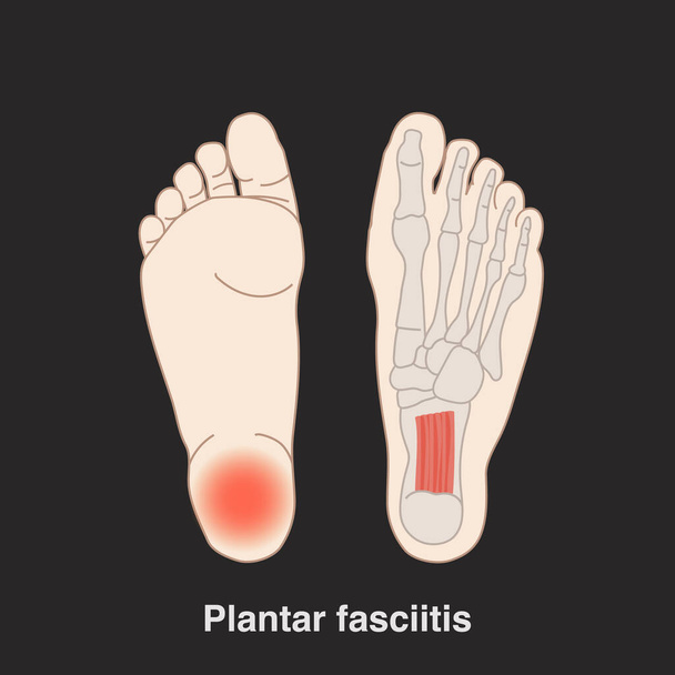 Vector hand drawn flat illustration plantar fasciitis infographic for medical studies. Isolated on black background. - Vector, Image