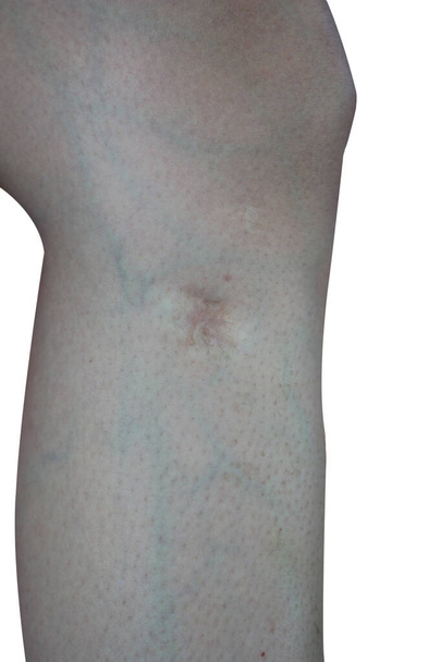 Ουλές στο δέρμα γύρω από τα πόδια, ουλή στο πόδι ενός κοριτσιού από κοντά. Φλεβίτιδα από το τραύμα στο πόδι που απομονώθηκε σε λευκό φόντο. - Φωτογραφία, εικόνα