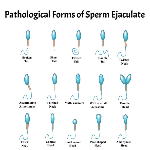 A sperma kóros formái az ejakulátumban. Férfi meddőség Oligospermia. Spermogram. Sperma patológia típusok. Sperma rendellenességek. Infografikák. Vektorillusztráció izolált háttérrel. - Vektor, kép