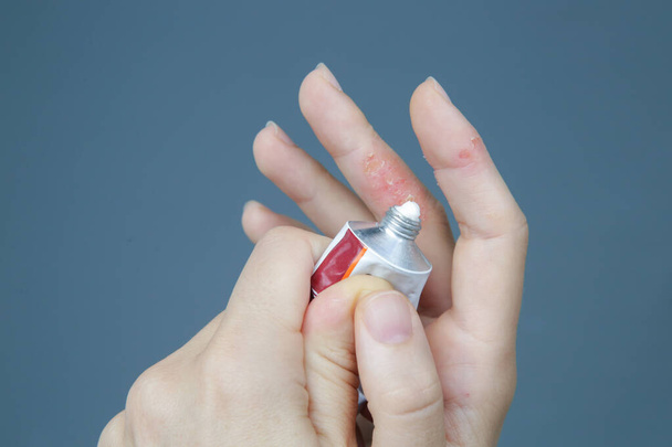 Dermatite atopique de la main. Eczéma sur les doigts
.  - Photo, image