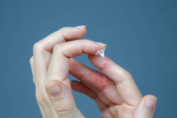 Dermatite das mãos atópica. Eczema nos dedos
.  - Foto, Imagem