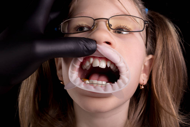 Le médecin examine les dents de l'enfant. Un enfant aux dents tordues. Photo studio sur fond noir
. - Photo, image