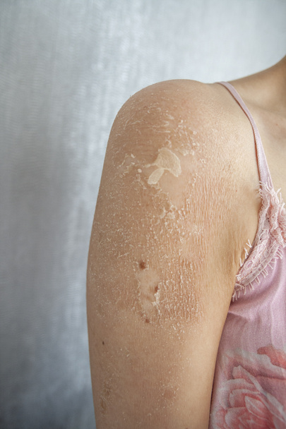 Primer plano de Eczema (Dermatitis), Alergia, Psoriasis, Hongos, Piel seca o quemada. Cierre del Hombro. Concepto de salud
. - Foto, imagen