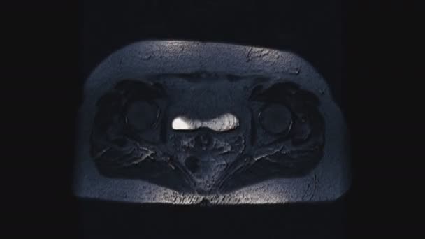 Pooperacyjny tomowy kolor MRI narządów żeńskich do wykrywania przerzutów - Materiał filmowy, wideo