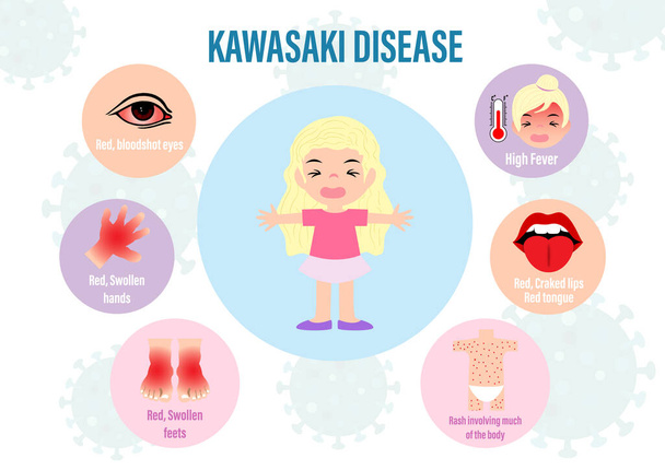 Illustration graphique de la maladie de KAWASAKI chez l'enfant avec caractère de dessin animé et lettrage sur les symboles de virus et fond blanc. Affiche médicale de la maladie de Kawasaki dans la conception vectorielle
. - Vecteur, image