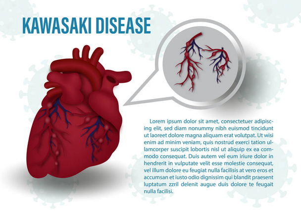 Nahaufnahme menschliches Herz mit den Kawasaki Symptomen an roten Blutgefäßen, dem Namen und Beispieltexten auf Virussymbolen und weißem Hintergrund. Medizinisches Plakat der Kawasaki-Krankheit im Vektordesign. - Vektor, Bild