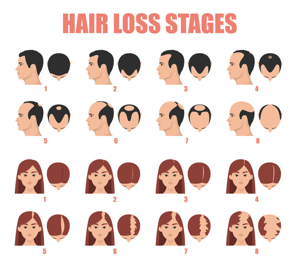 Las etapas de pérdida de cabello vector aislado. alopecia femenina y masculina. Juego de proceso de balanceo. Hombres y mujeres sin pelo. - Vector, imagen