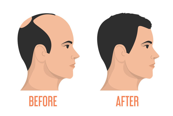 Haittransplantation vor und nach Vektor isoliert. Alopezie-Behandlung, vergessen Sie die Glatze. Haarloser Mann. - Vektor, Bild