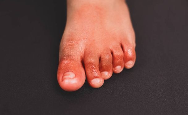 Болезненное красное воспаление на пальце ноги, называемое ковидные поражения пальцев ног странный признак новых симптомов коронавируса или инфекций
 - Фото, изображение