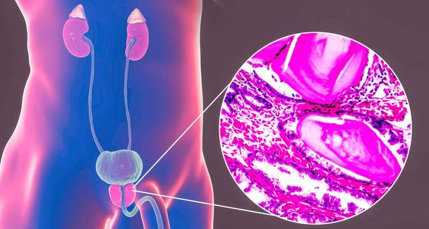 Доброкачественная гиперплазия предстательной железы, 3D-иллюстрация, показывающая увеличение предстательной железы и фотомикрограф, показывающий расширенные железы, обволакивание эпителиальных клеток железы, кистозное расширение
 - Фото, изображение
