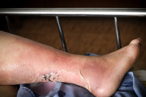 Cukorbeteg emberek lába, tompa és duzzadt. A cukorbetegség toxicitása miatt fekély  - Fotó, kép