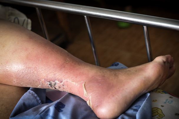 Τα πόδια των ανθρώπων με διαβήτη, θαμπό και πρησμένο. Λόγω της τοξικότητας του διαβήτη, εξέλκωση  - Φωτογραφία, εικόνα