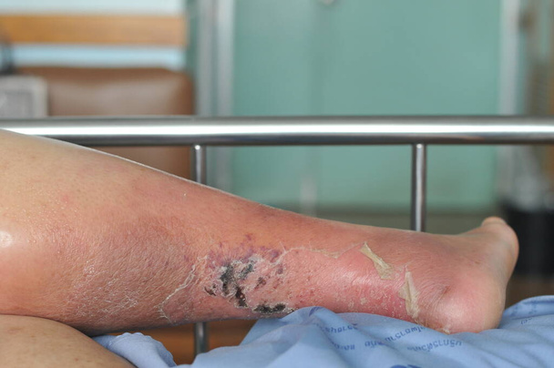 Die Füße von Menschen mit Diabetes, stumpf und geschwollen. Aufgrund der Toxizität von Diabetes, Geschwüren  - Foto, Bild