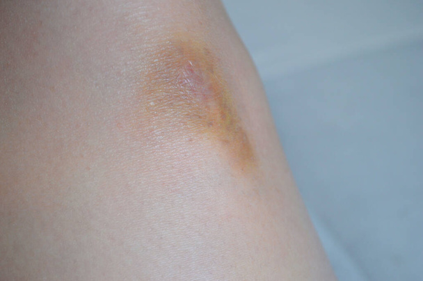 打撲膝にクリームを塗る女性。膝に軽い背景で打撲傷を負う。医療従事者の日。世界トラウマの日 - 写真・画像