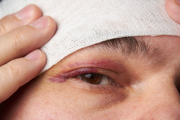 Nahaufnahme eines Blutergusses in der Nähe des Auges, das Gesicht eines Mannes mit Hämatom - Foto, Bild