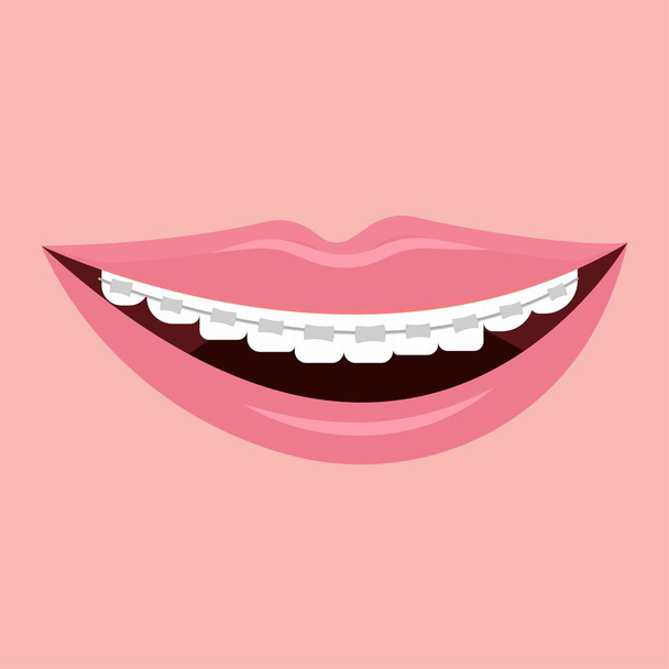 Smile with braces, brekets stock vector illustration isolated on white background. Stomatology, orthodontic, healthcare concept. Dental equipment for correction. White teeth, hygiene. - Vector, Image
