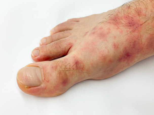 Close-up van de voet en tenen van de man met rode huiduitslag desease op een witte achtergrond. Voorraadafbeelding. - Foto, afbeelding