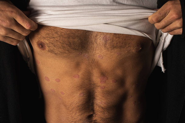 a man with psoriasis shows a disease of the abdomen - Photo, Image
