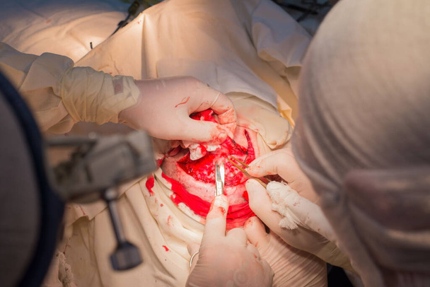 上の図患者の頭蓋骨にチタン板を設置するための神経外科手術の段階です小児神経外科開胸。頭皮の切開.電気凝固剤で頭の出血を止めます。頭皮の頭皮に止血クランプ.トゥイー - 写真・画像