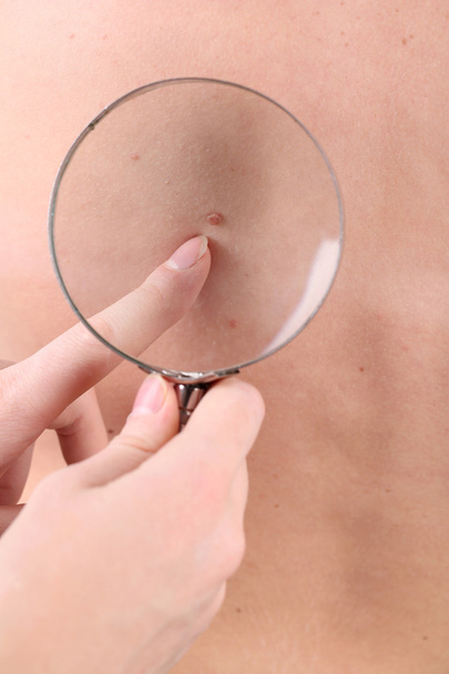 Dermatologist examines a birthmark of patient, close up - Foto, immagini
