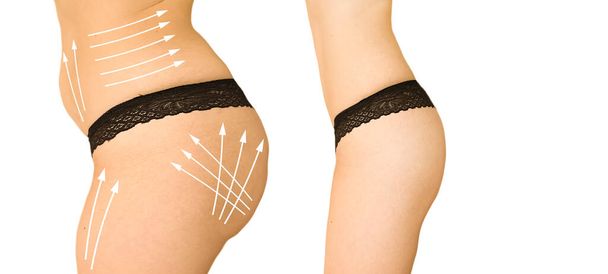  zeštíhlení ženského těla před a po, liposukce - Fotografie, Obrázek