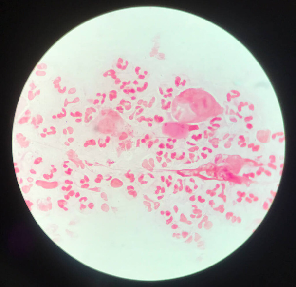 Slide show Gram negative diplococci in pus from penis. screening test for Neisseria gonorrhoeae sexually transmitted. screening test for Neisseria gonorrhoeae sexually transmitted. - 写真・画像