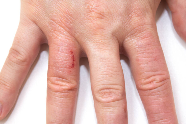 Dermatitis de manos. Eczema de mano cerrado sobre fondo blanco. La dermatitis es una inflamación de la piel
 - Foto, Imagen