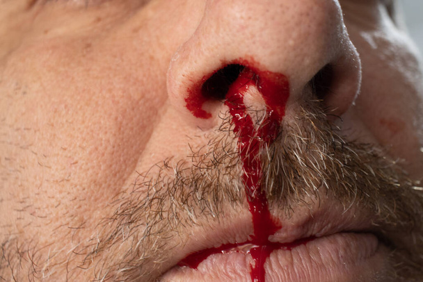nosebleed , A man is bleeding from his nose - 写真・画像
