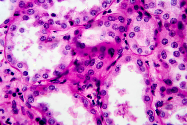 Хронический пиелонефрит, светлый микрограф, фото под микроскопом. Высокое увеличение - Фото, изображение