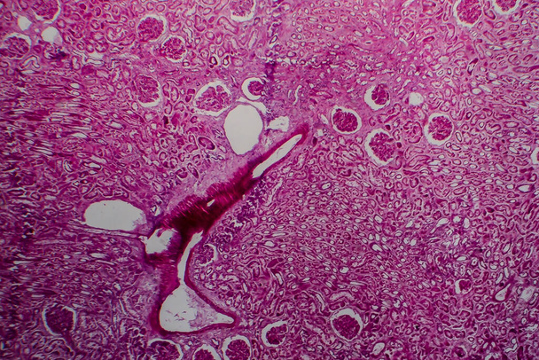 Histopatologia rozproszonego zapalenia kłębuszków nerkowych, mikrograf świetlny, zdjęcie pod mikroskopem - Zdjęcie, obraz