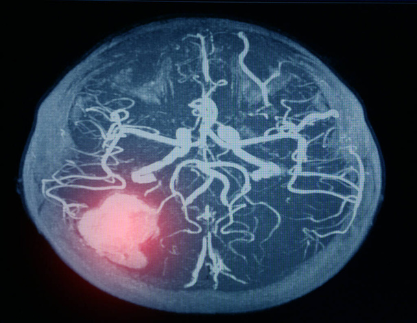 MRA agy vagy mágneses rezonancia angiográfia kép (MRA) az agyi artéria a vérzés az agyban. - Fotó, kép