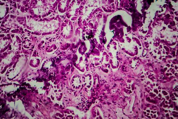 Histopatologia rozproszonego zapalenia kłębuszków nerkowych, mikrograf świetlny, zdjęcie pod mikroskopem - Zdjęcie, obraz