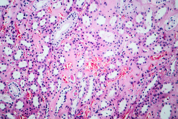 Histopathologie hypertensiver Nierenerkrankungen, Lichtmikroskopie, Foto unter dem Mikroskop - Foto, Bild