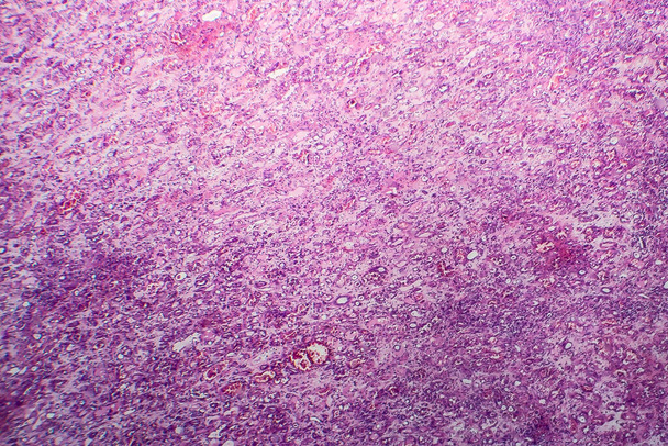 Histopatologia da nefrite intersticial, micrografia leve, foto sob microscópio - Foto, Imagem