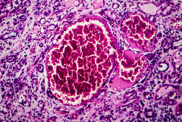 Histopatologia śródmiąższowego zapalenia nerek, mikrograf świetlny, zdjęcie pod mikroskopem - Zdjęcie, obraz