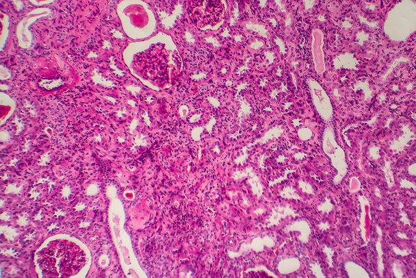 Χρόνια πυελονεφρίτιδα, μικρογραφία φωτός, φωτογραφία στο μικροσκόπιο - Φωτογραφία, εικόνα