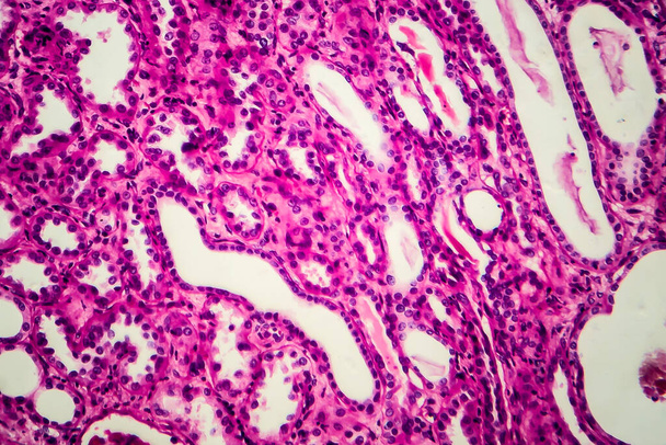 慢性腎炎,軽いマイクログラフ,顕微鏡下の写真 - 写真・画像
