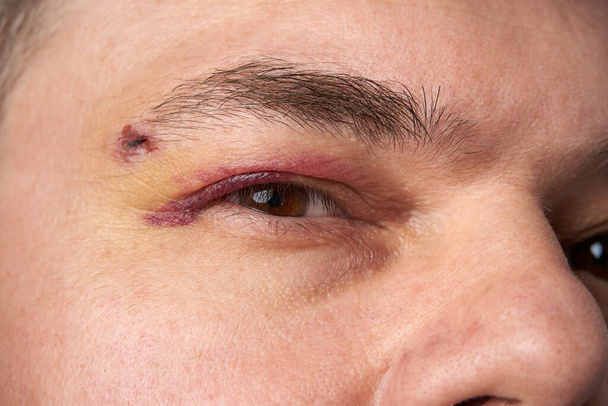 közeli látvány egy zúzódásról a szem közelében, egy hematómás férfi arcáról. - Fotó, kép