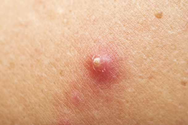 pimple extreme on human skin. macro - Photo, Image