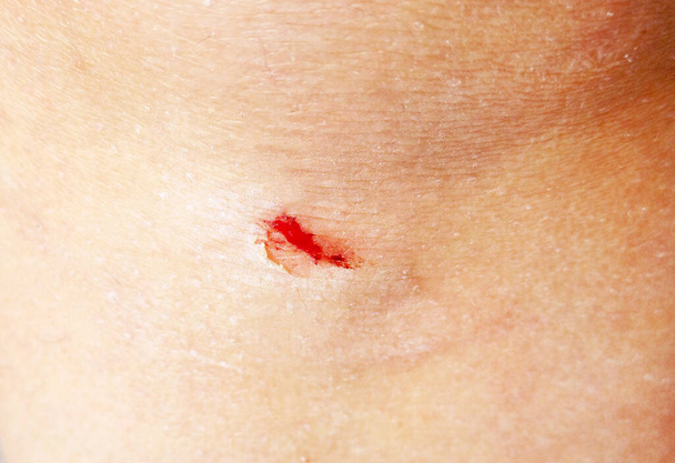 Close-up van een kleine wond op de knie - Foto, afbeelding