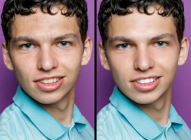 Before and after cosmetic operation. Young man portrait. Before and after cosmetic or plastic procedure, anti-age therapy, removal of acne, retouching. studio shot - Fotografie, Obrázek