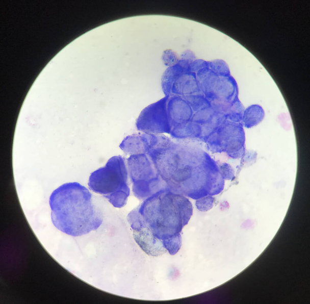 Komórka wielonukleinowa w badaniu Tzancka z mikroskopem w laboratorium. - Zdjęcie, obraz